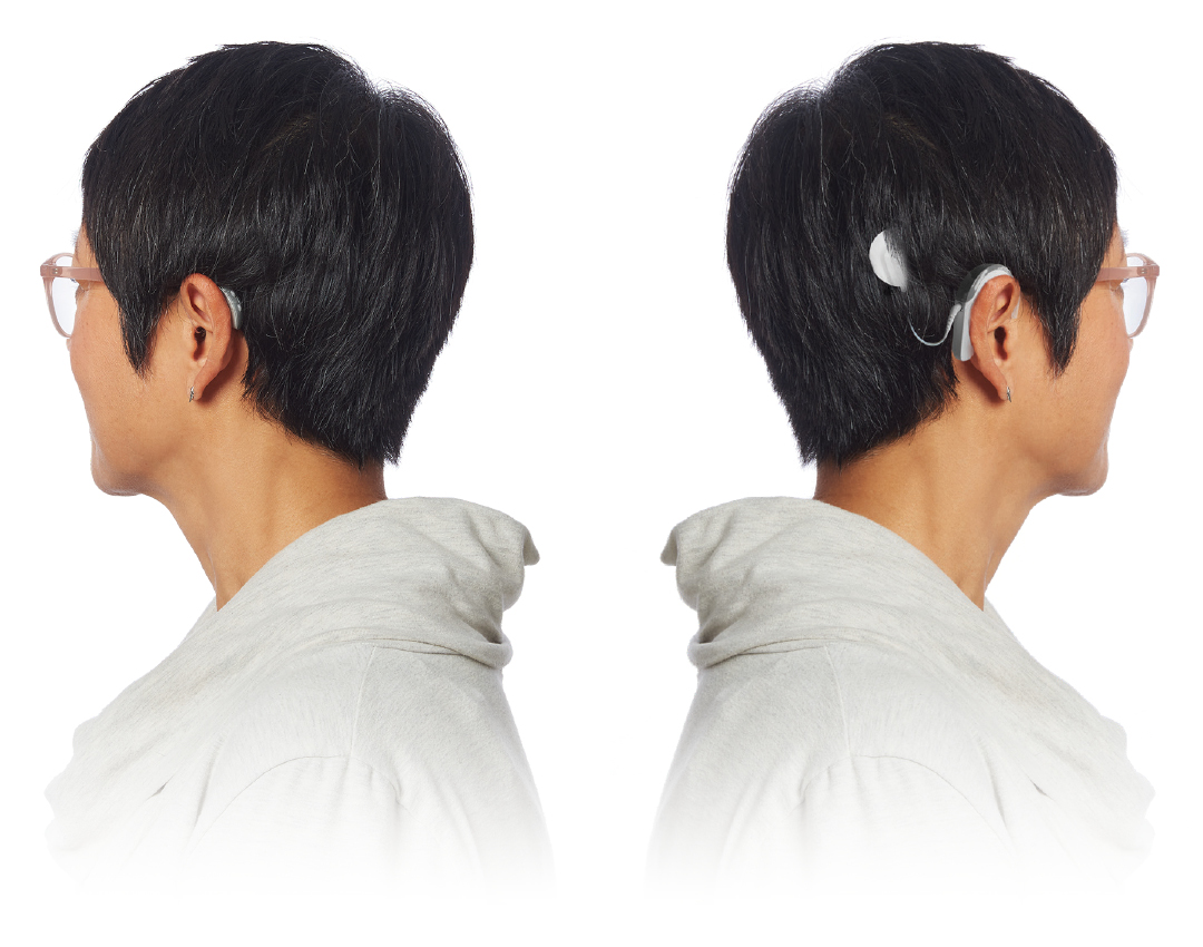 Two heads - one showing a hearing and one showing a cochlear implant